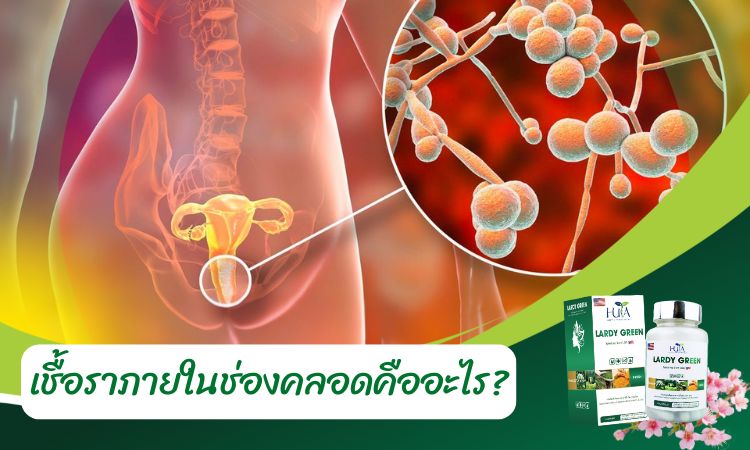 การติดเชื้อราในช่องคลอด