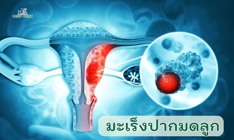 ภาวะปากมดลูกปลิ้นสามารถลุกลามกลายเป็นมะเร็งปากมดลูกได้
