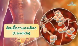 ติดเชื้อราแคนดิดา (Candida)