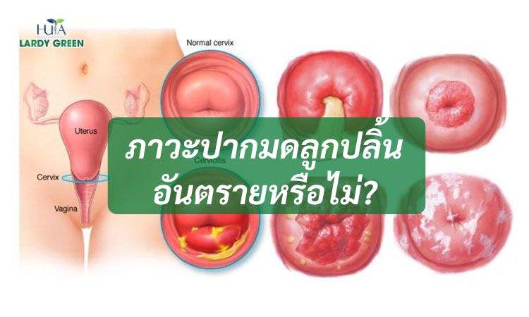 ภาวะปากมดลูกปลิ้นอันตรายหรือไม่?